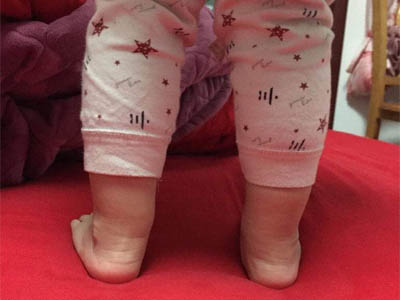 两岁多宝宝x型腿照片图片